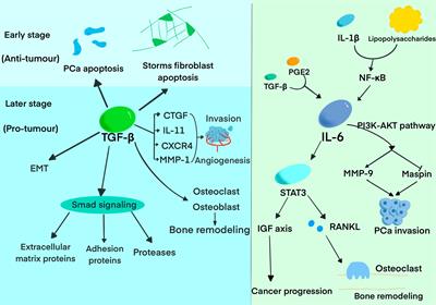 Role of Interleukin-1 family in bone metastasis of prostate cancer